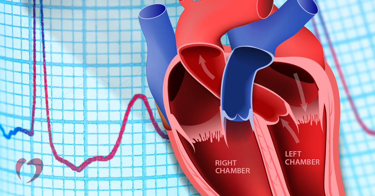 1st 2nd 3rd Degree Heart Block E VEDA8