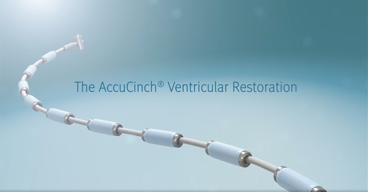 AccuCinch® Ventricular Restoration System | Oklahoma Heart Hospital