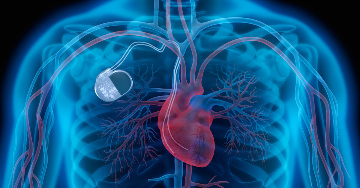 Types of Implantable Cardiac Devices | Oklahoma Heart Hospital