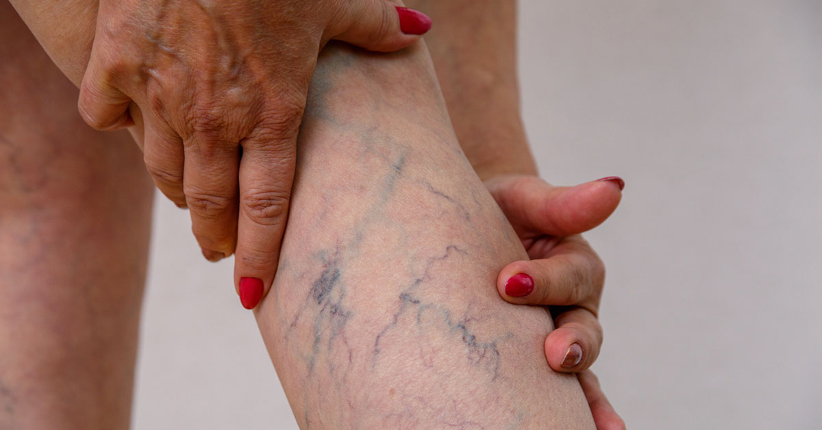 Varicose Veins: Causes, Symptoms And Treatment