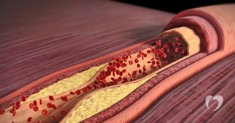 Preventing Plaque Buildup in the Arteries