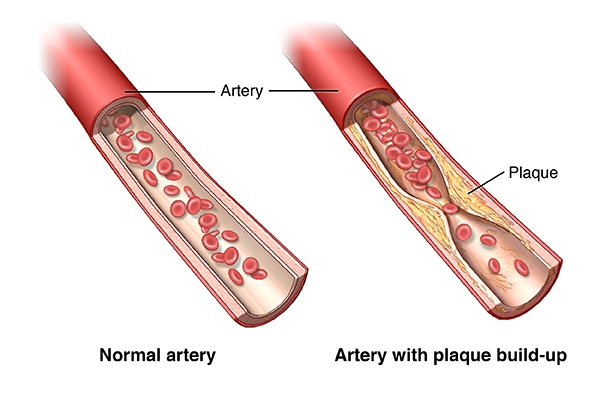 Peripheral Vascular Disease