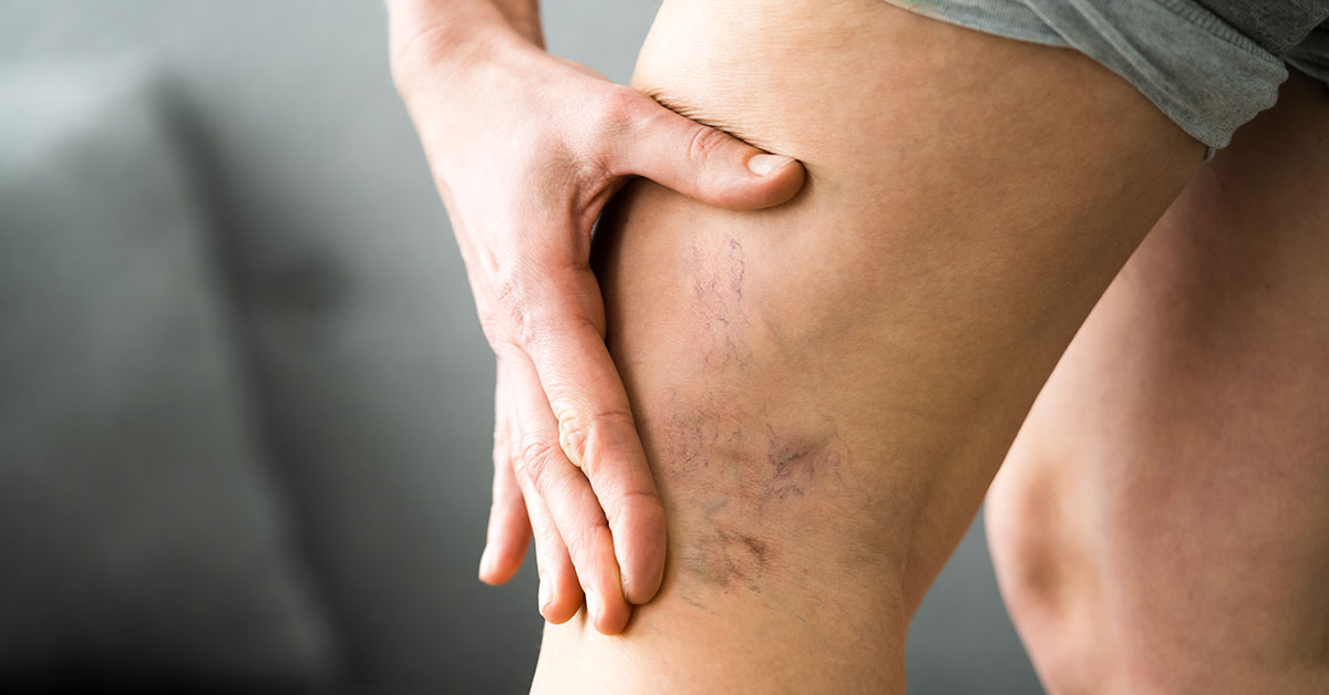 Treatments for Vein Disease