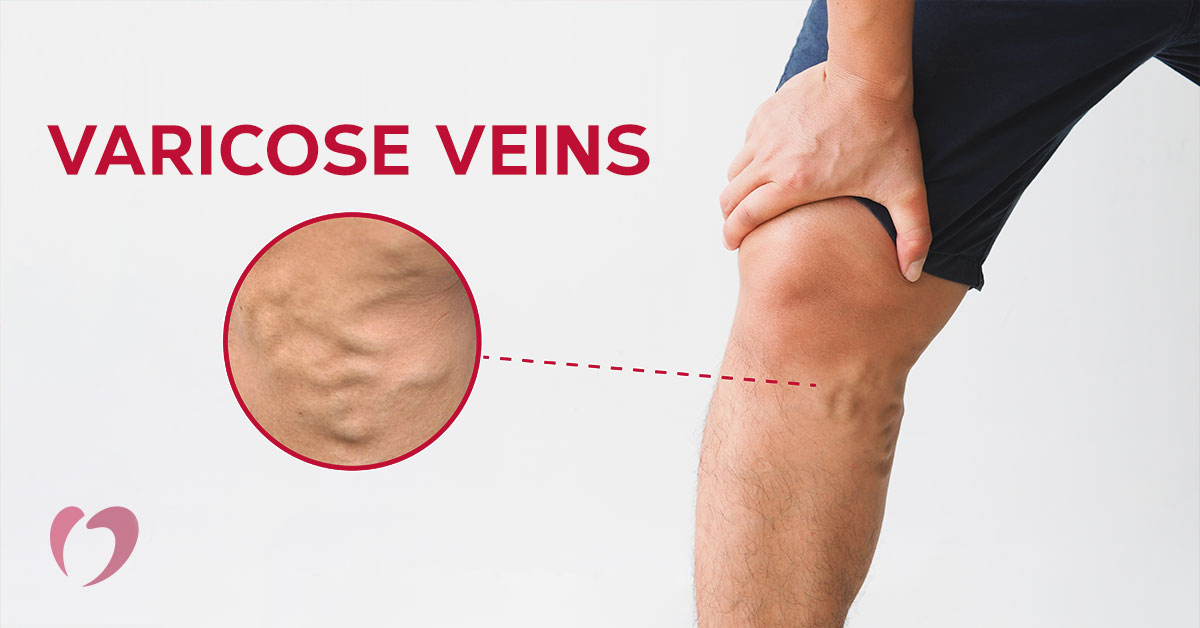 Varicose Vein Stripping Procedures: What to Expect