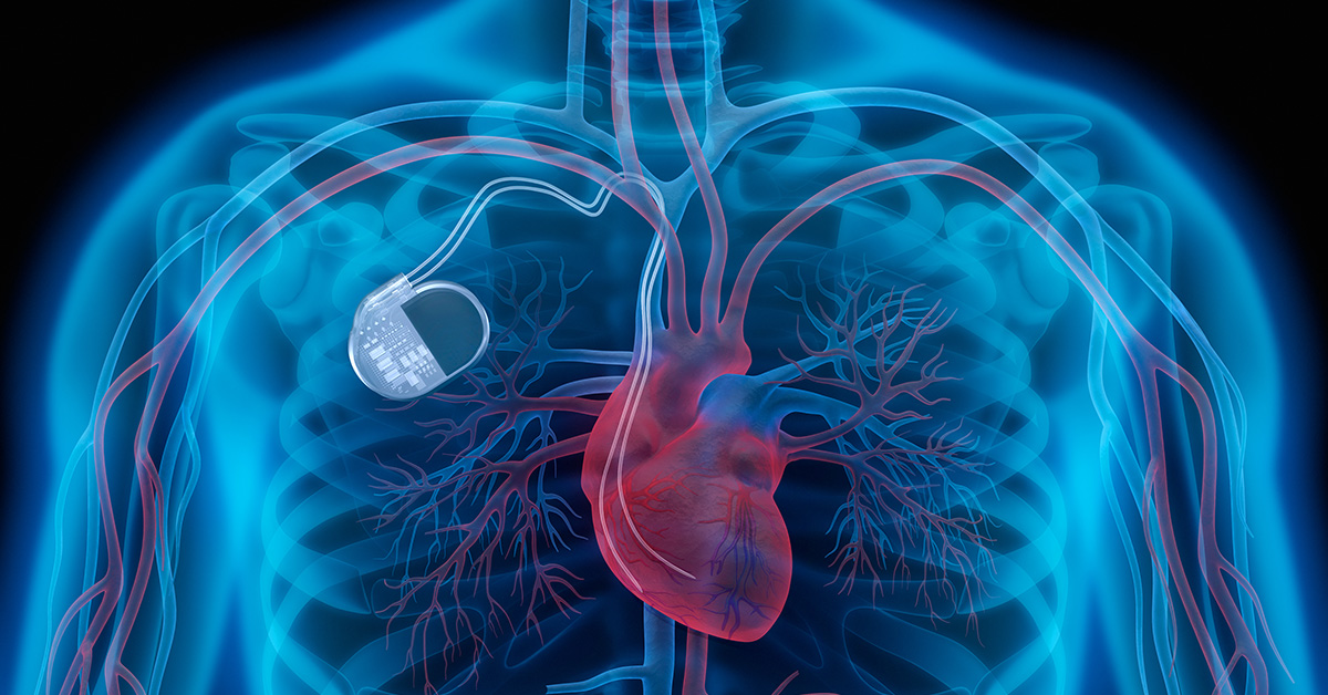 Cardiac Resynchronization Therapy (CRT) Pacemakers: Getting the Heart Back in Sync